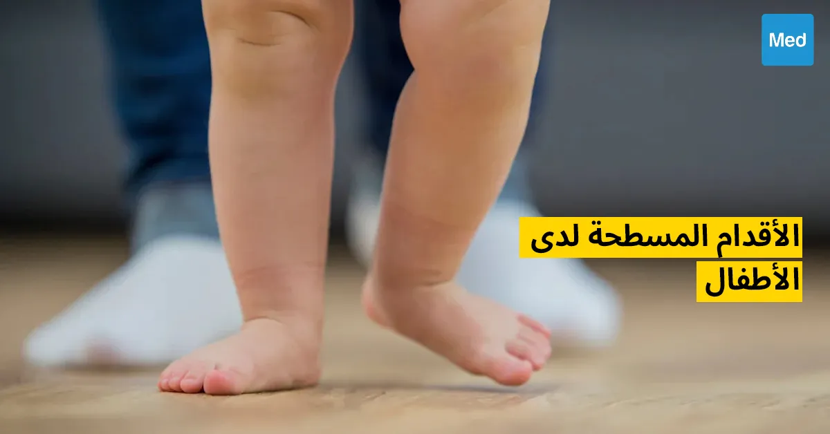 الأقدام المسطحة لدى الأطفال